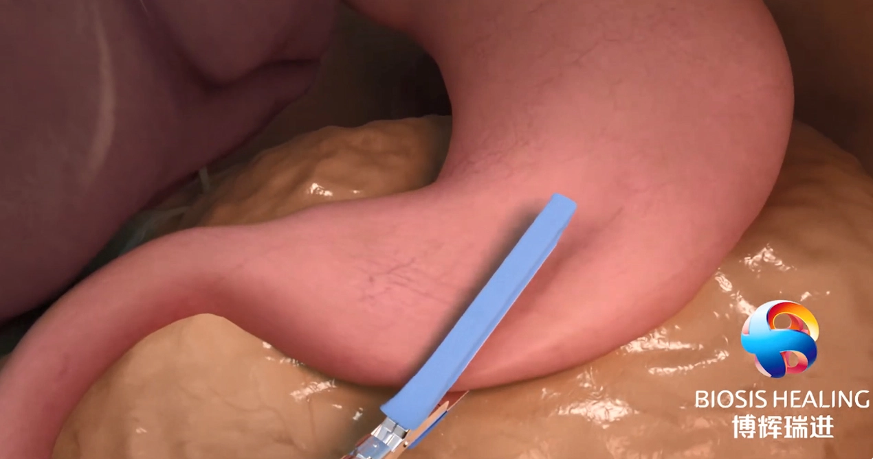 Refuerzo de línea de grapas (SLR) para reducir las fugas