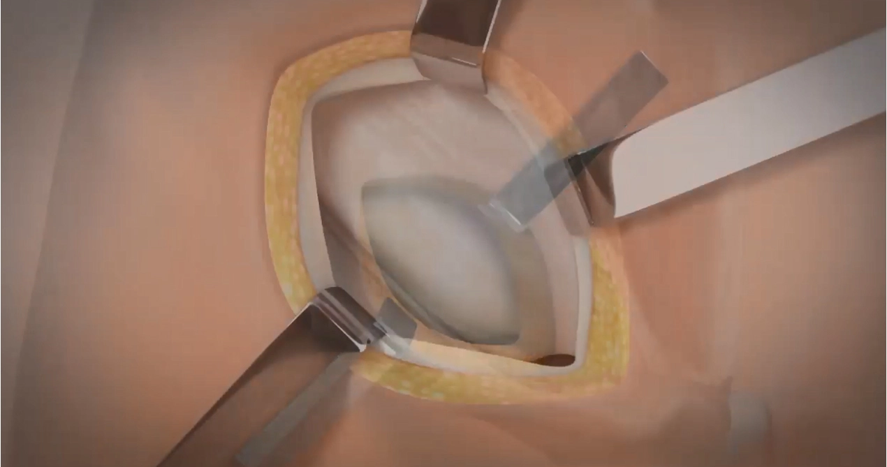 Reparación de hernia Lichtenstein con malla absorbible SIS