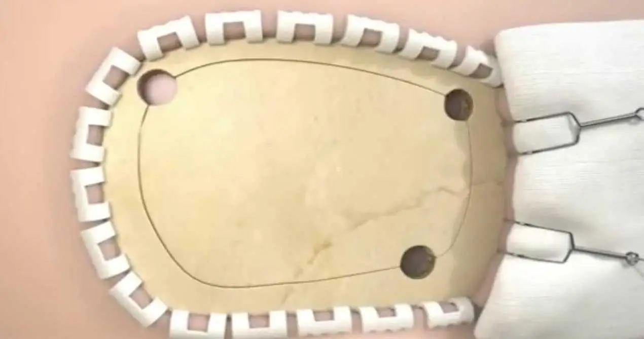 Parche de reparación de durales