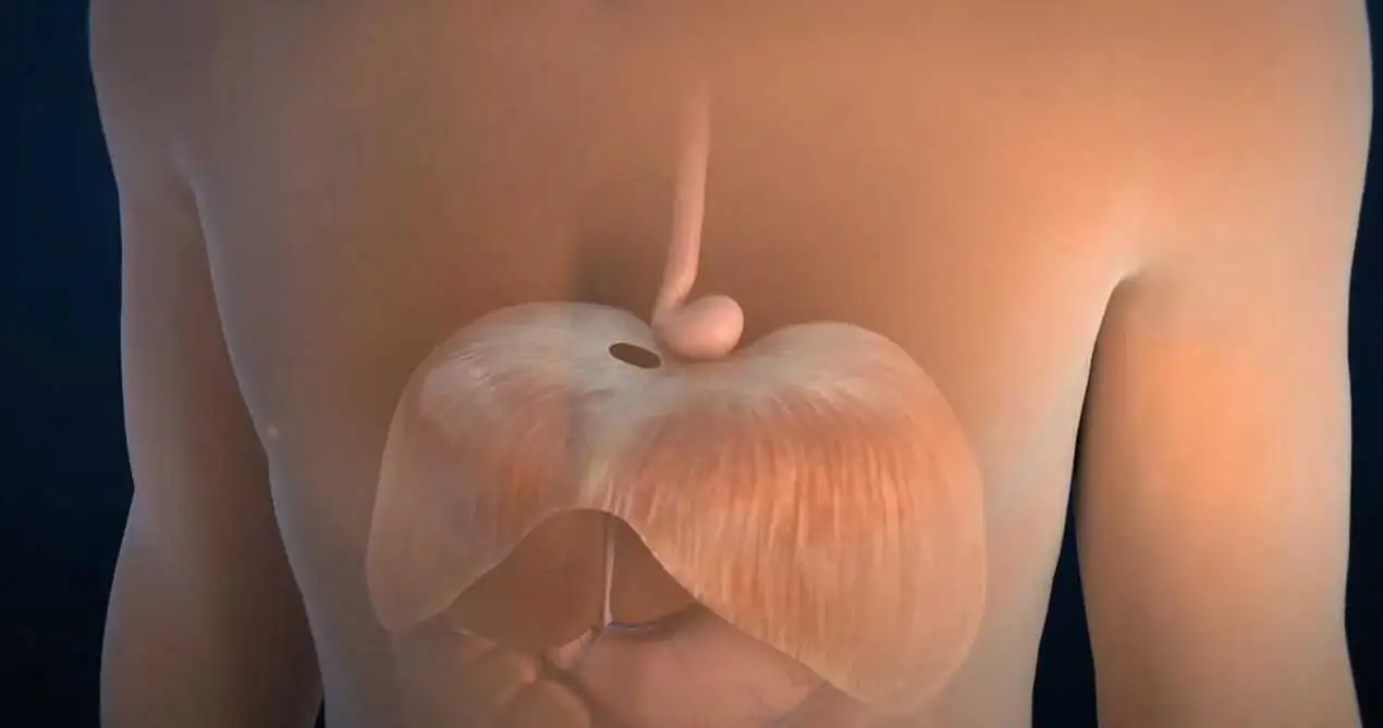 Reparación de hernia de hiato esofágico con mallas biológicas SIS