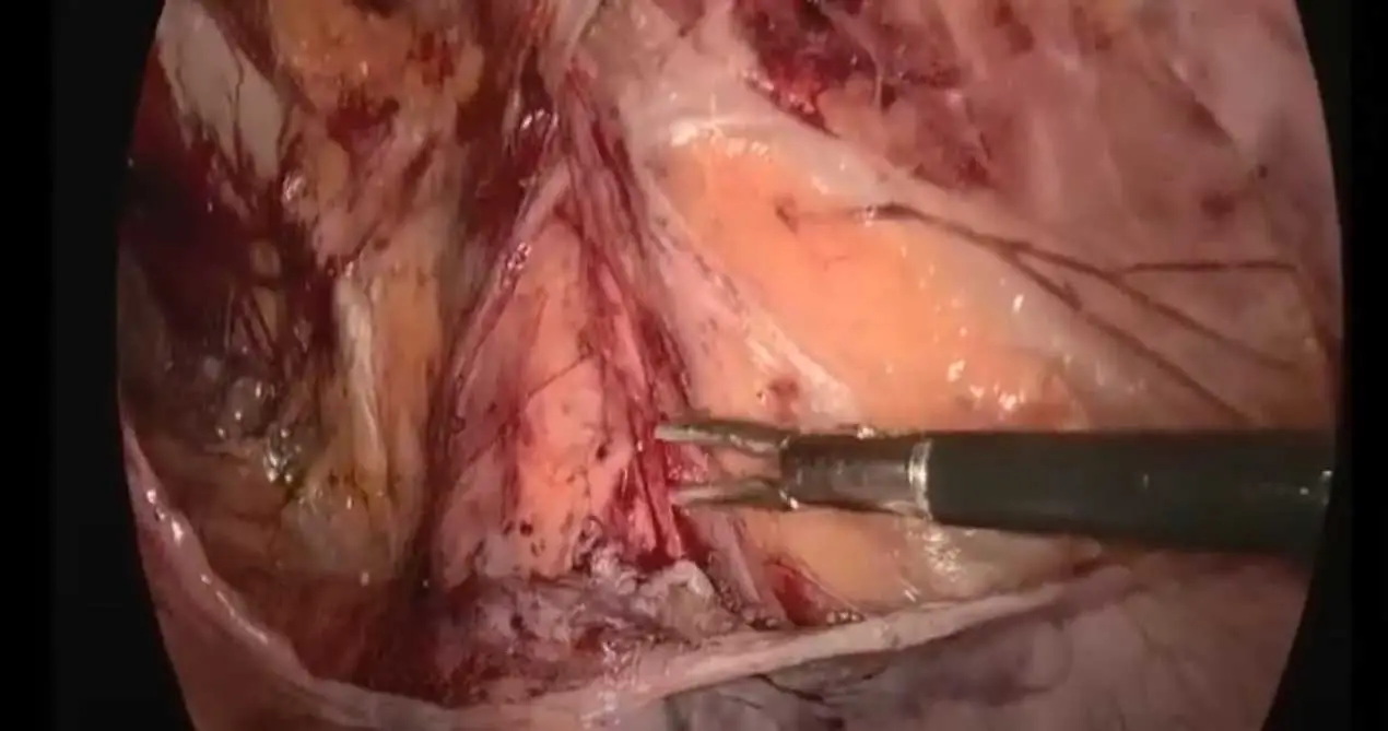 SIS Malla Biológica 13x15cm TAPP Cirugía para Reparación de Hernia