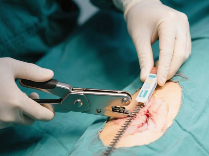 How-to-Use-a-Surgical-Stapler.jpg How-to-Use-a-Surgical-Stapler.jpg